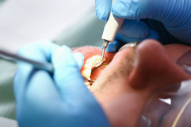 Best Emergency Wisdom Teeth Removal in Cordova, AL
