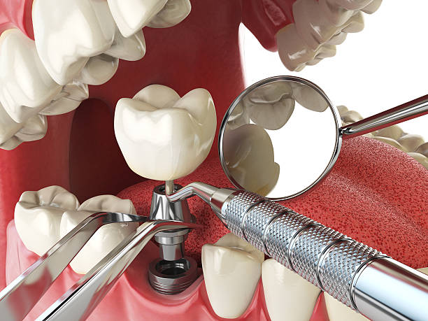 Best Emergency Treatment for Dental Infections or Abscesses in Cordova, AL