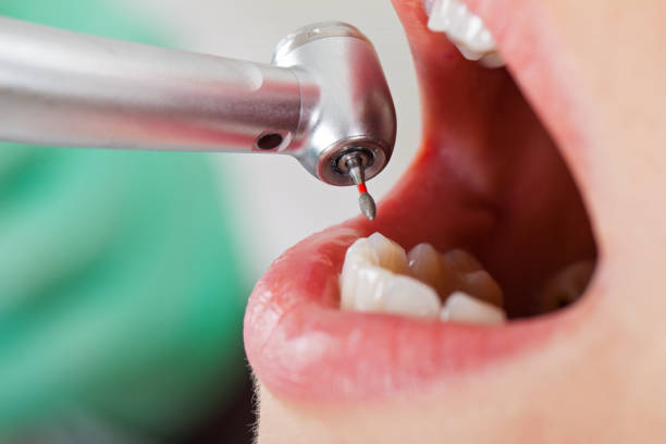 Best Emergency Dental Care for Broken or Chipped Teeth in Cordova, AL